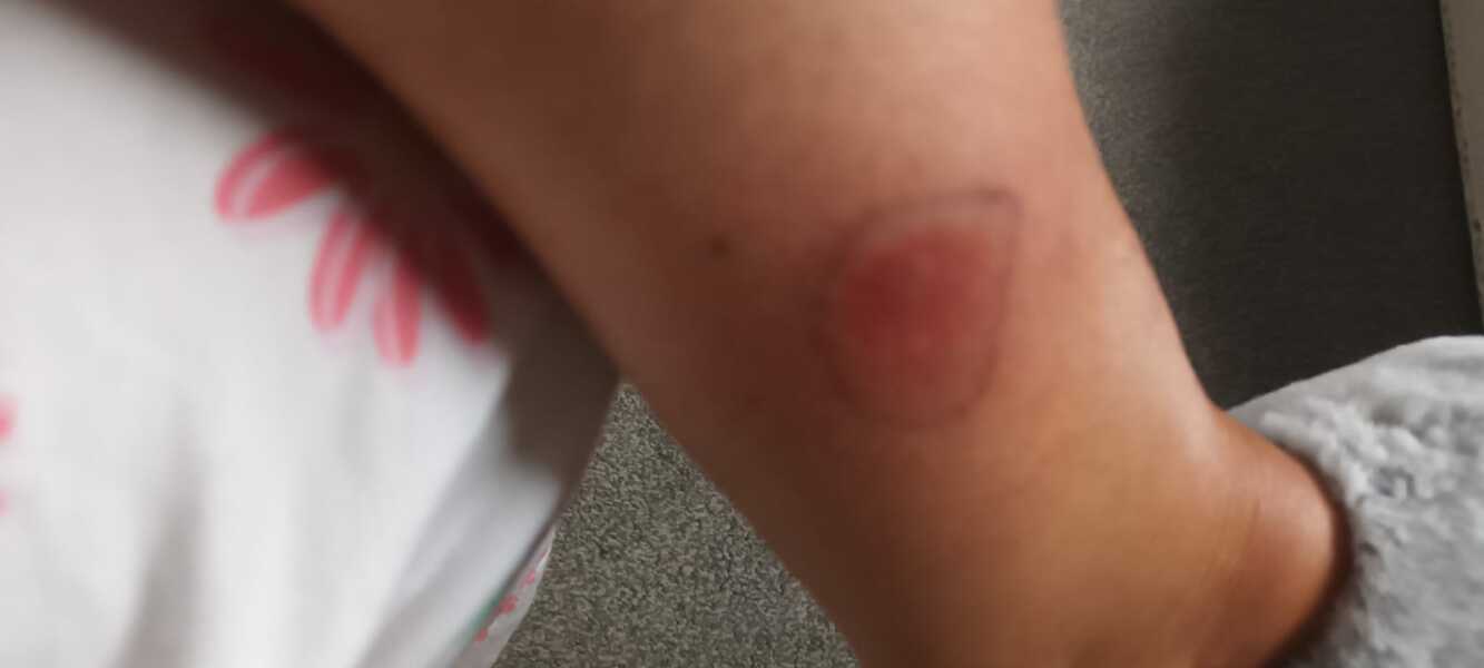 Does this look like a spider bite?