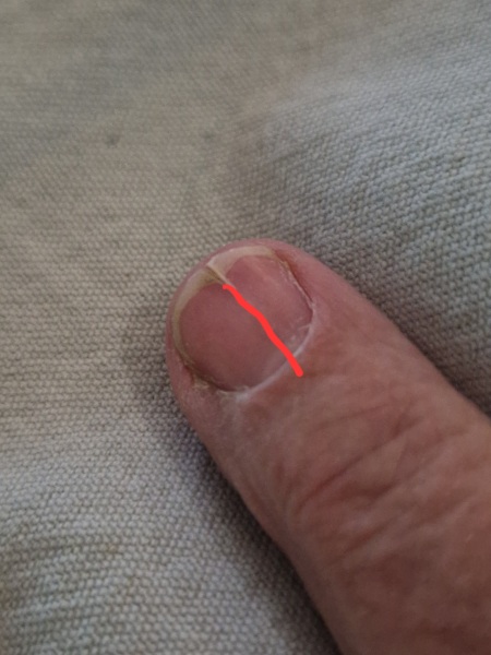 Is my nail fixable? (Pic attached)
