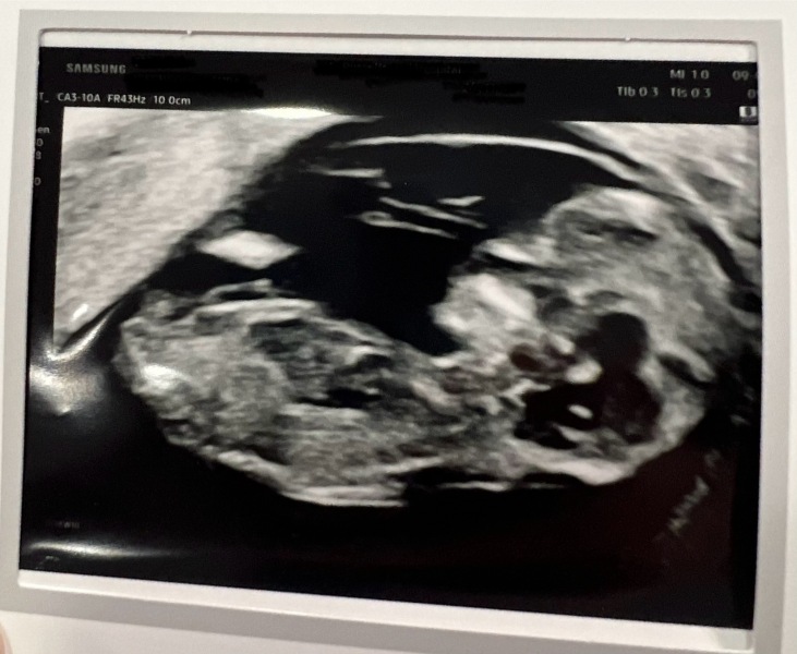 Pregnant after miscarriage