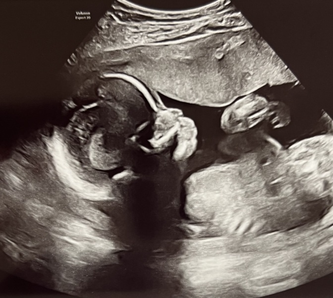 BFP after IVF - the journey continues (part 2)