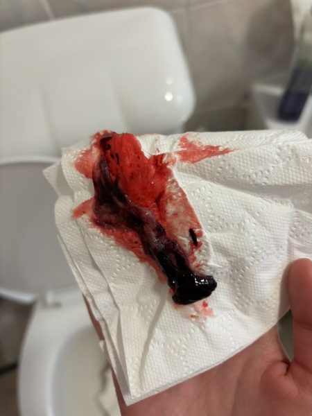 Is this my miscarriage? *warning - photo*