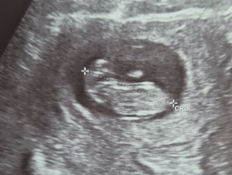 10 week scan, is this normal?