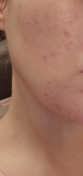 Acne at 30