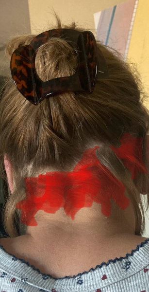 Is this Alopecia? Photo included