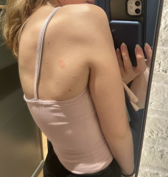 Teen daughter full body rash