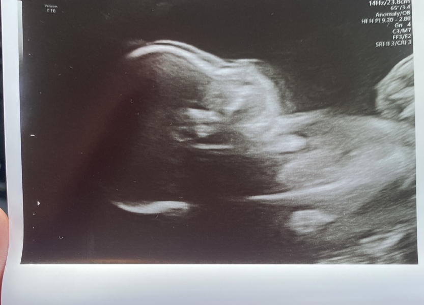 BFP after IVF - the journey continues (part 2)