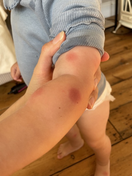 Advice please on mosquito bite