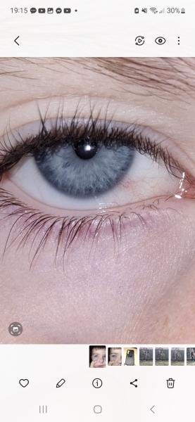 Bloodshot eye for days