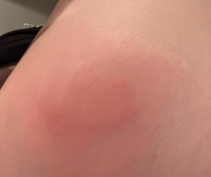 To be stung by a wasp at 1.30am