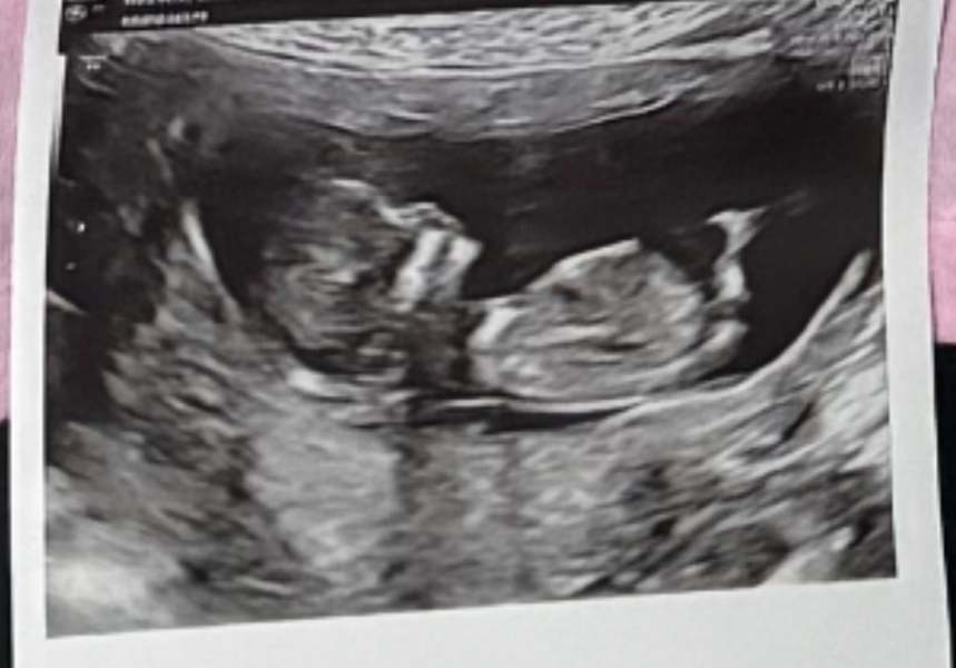 Not eating first trimester