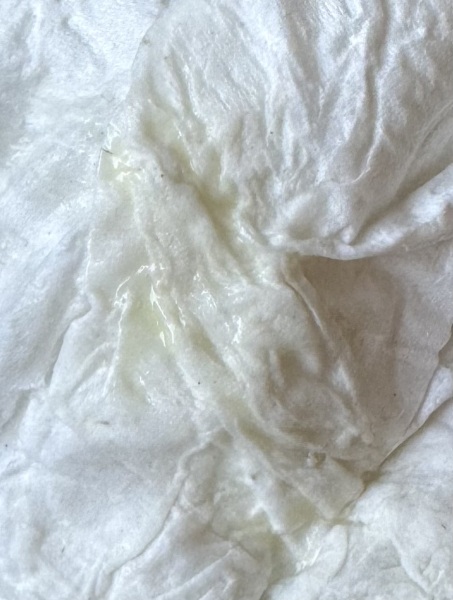 Yellow discharge & Pcos