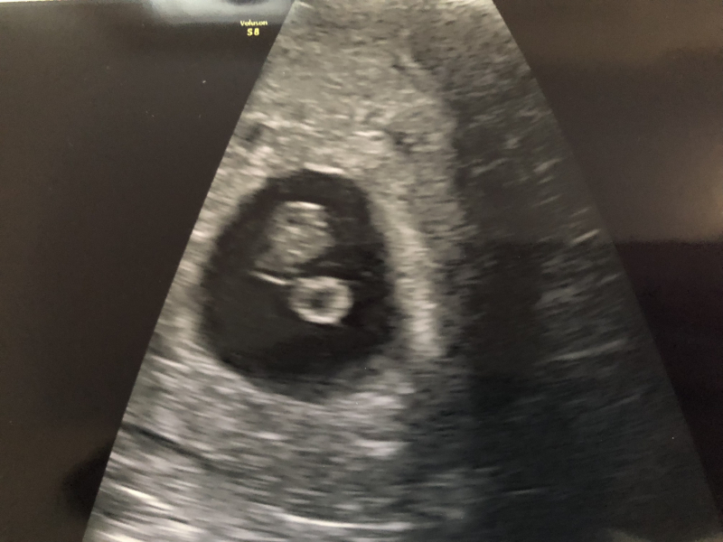Symptoms gone at 7 weeks