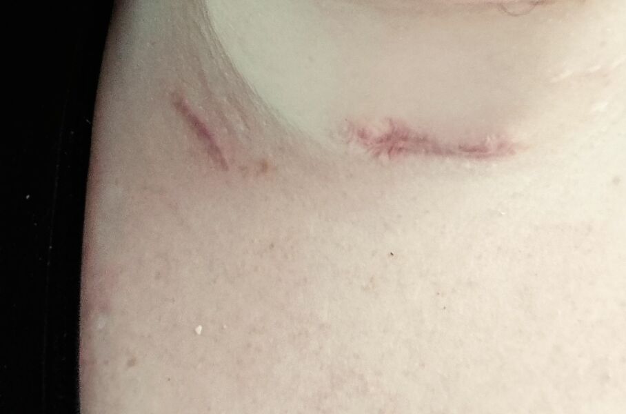 Can anyone recommend any decent scar creams?