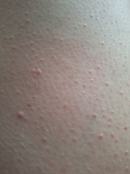 keratosis pilaris