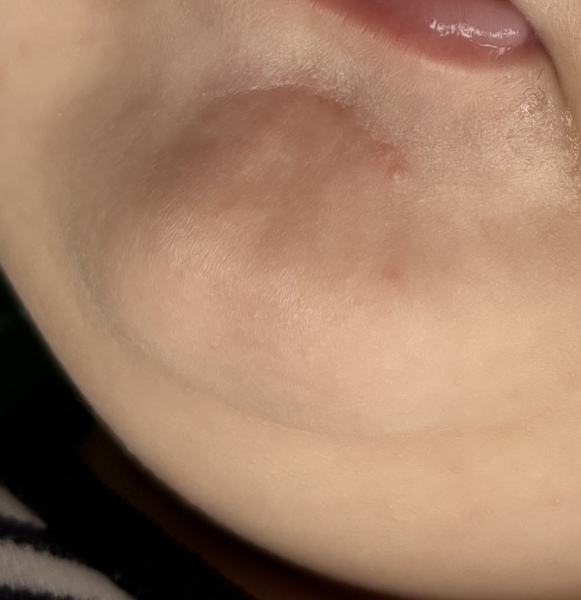 Is this baby acne at 4 months old?