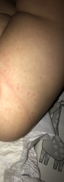 What do you think this rash is?