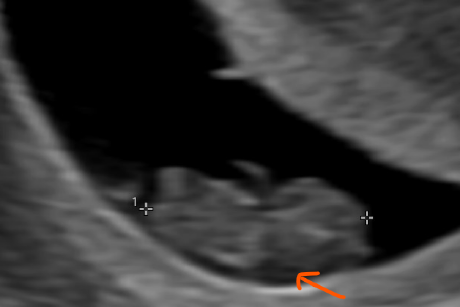 Terrified of my NT scan at 12 weeks - I think I see I big fluid patch on 8 week scan