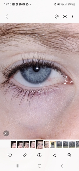 Bloodshot eye for days