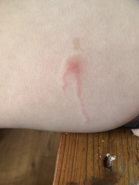 Insect bite (posting for traffic)