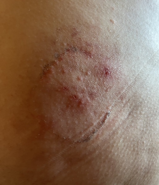 Rash from HRT patch, or shingles?