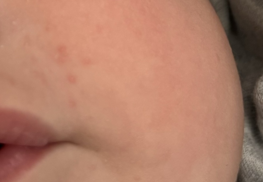 Is this baby acne at 4 months old?