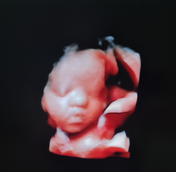 Help has baby got down syndrome?
