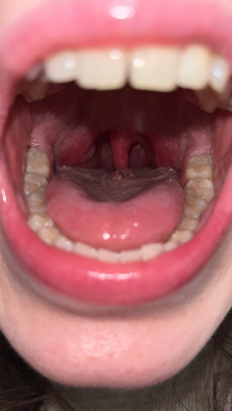 Is this quincy or tonsillitis?