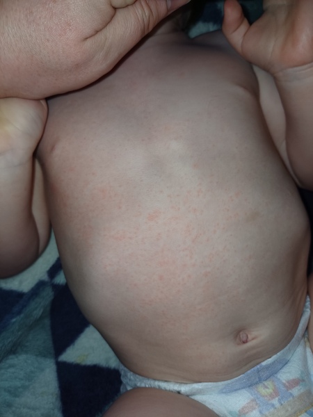 Rash help!