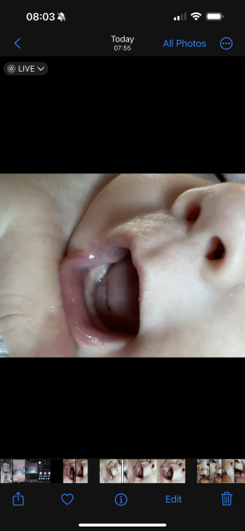 Tooth? Epstein pearls ? Or something else