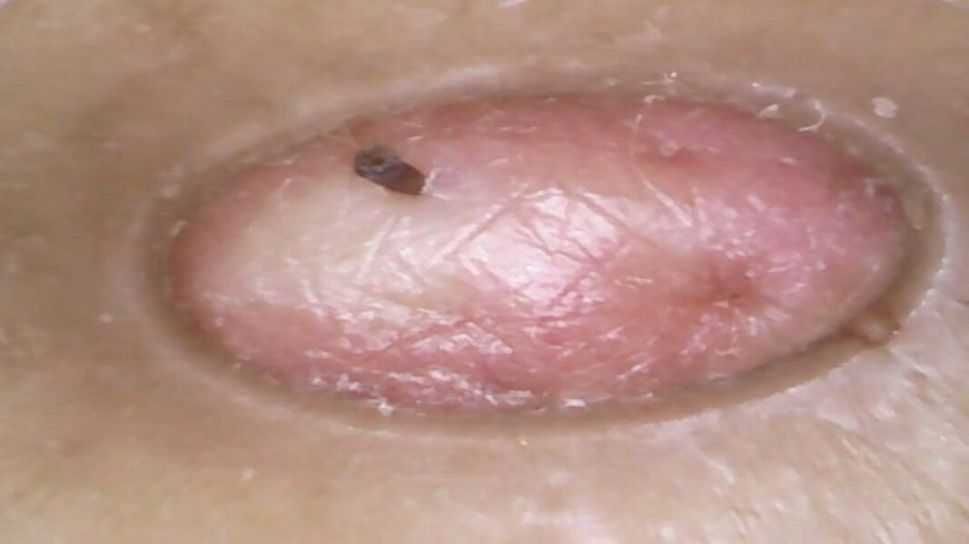 Massive blackhead evacuating in high definition
