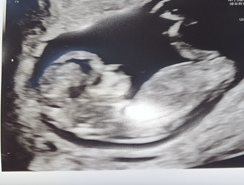 BFP after IVF - the journey continues (part 2)
