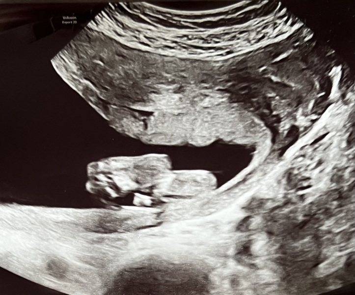 BFP after IVF - the journey continues (part 2)