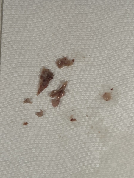 Can you blow a nasal polyp out? 