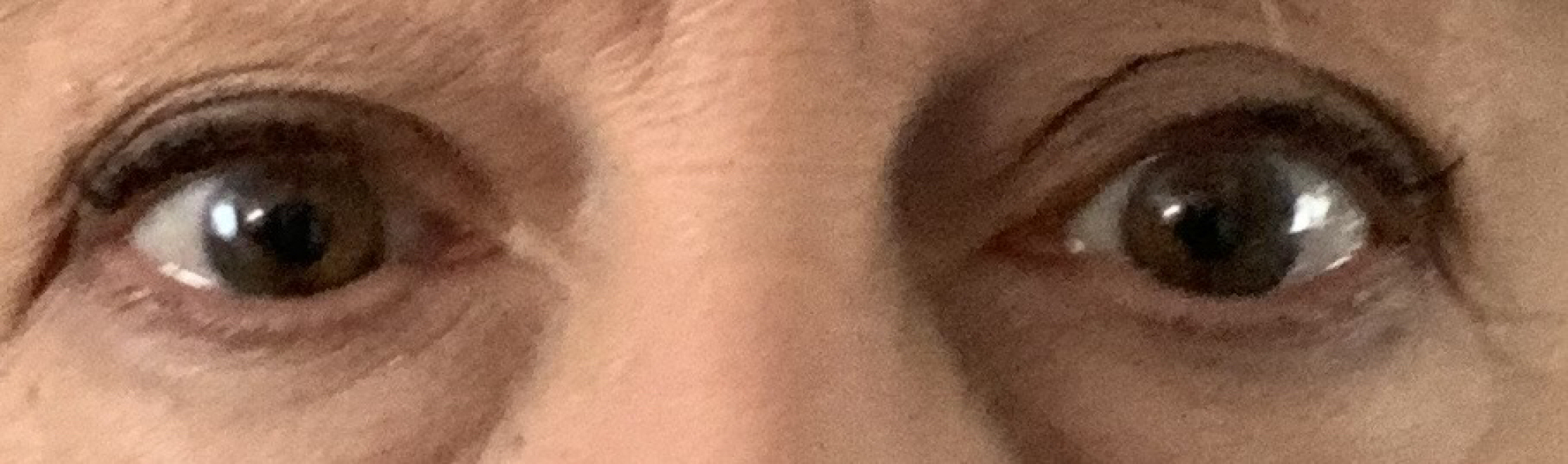 Weird change in eye shape .. help !