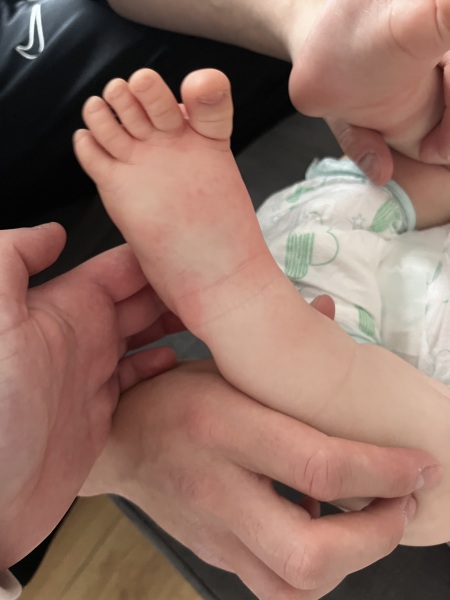 Weird spots that calm down and flair up