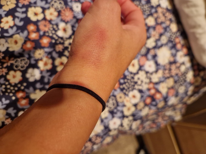 What could this mark on my hand be?