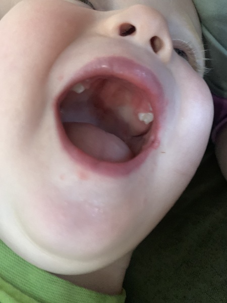 Second molar teething