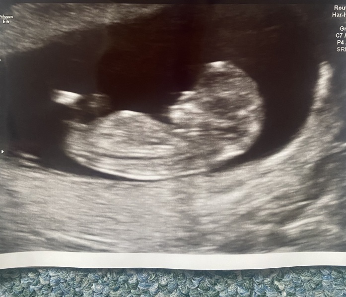 No symptoms/symptom loss in pregnancy