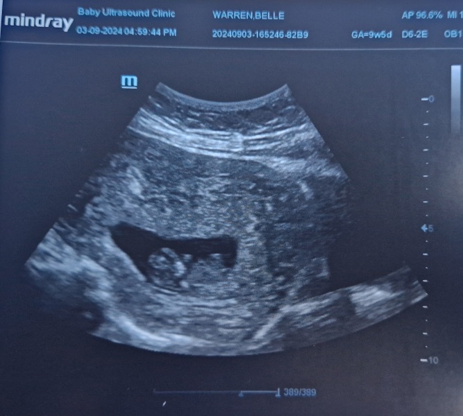 TMI picture! 6 wk pregnant spotting?