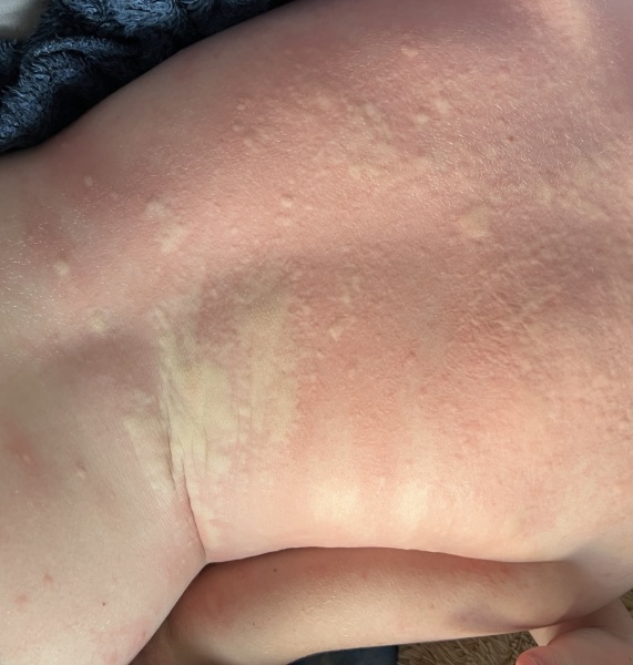 5 year old ds broke out in hives this weekend and keep coming back