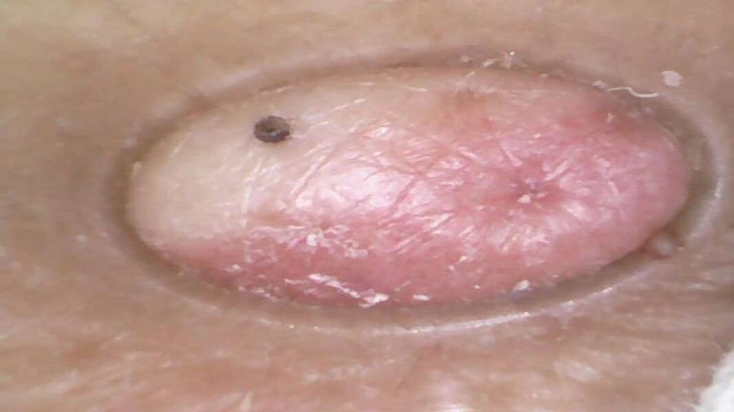 Massive blackhead evacuating in high definition