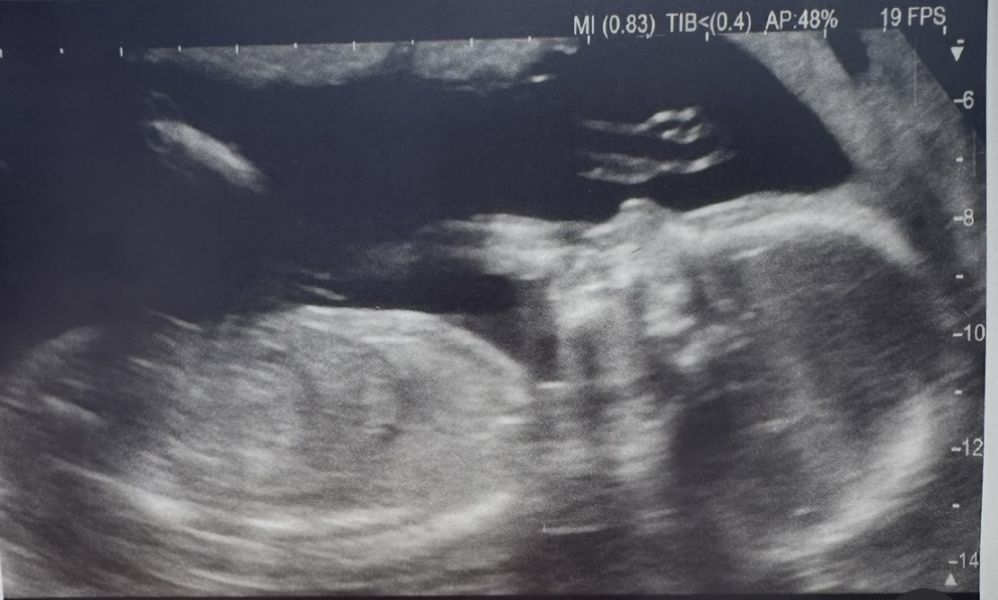 BFP after IVF - the journey continues (part 2)