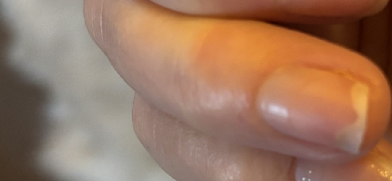 Why's my nail like this