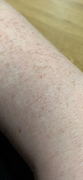 little white growth on skin