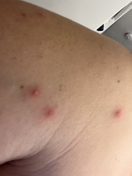 Is this chicken pox? << TW pics included >>