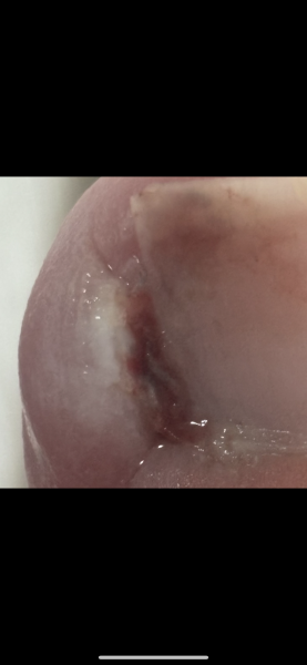 Gross pic. Can anyone who has had a partial nail avulsion help