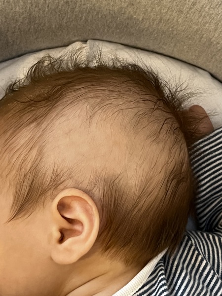 Hair loss in 3 month old