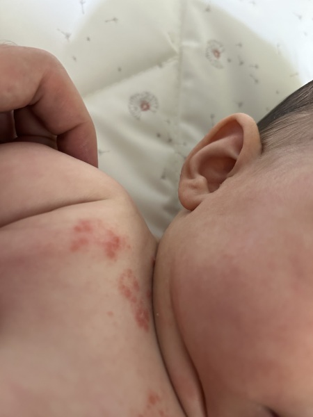 Baby rash