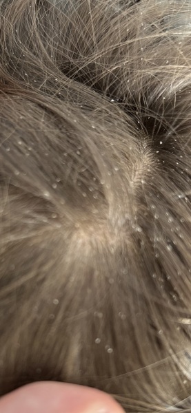 At wits end with son’s hair / scalp.. please help!! (Photo included)