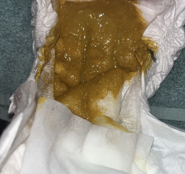 ? CMPA poo or normal